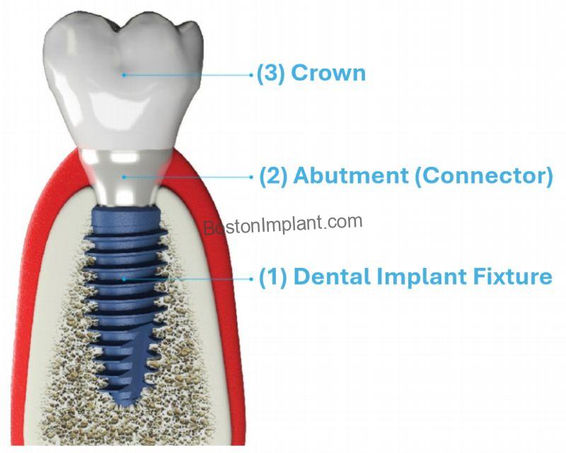 Structure of dental implants