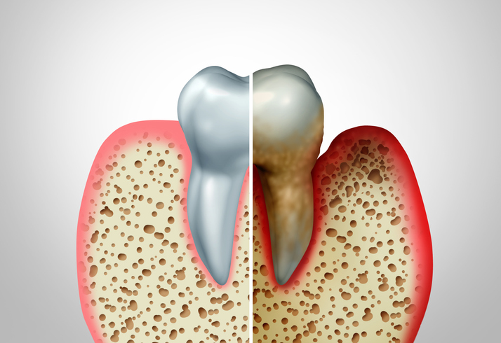 Understanding and Treating Advanced Gum Disease (Periodontal Disease)