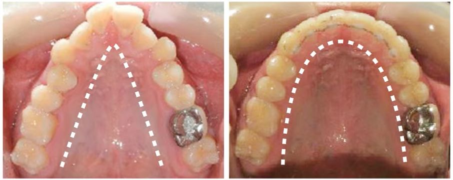 Boston Teeth extraction