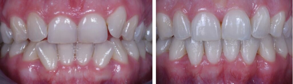 teeth straightening services in boston