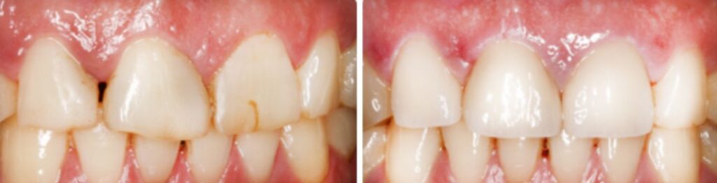 Veneer dentist downtown