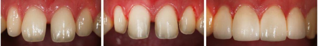 boston veneer treatment