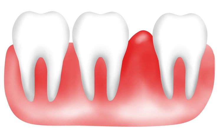 Bleeding Gums: Common Causes and How to Stop the Bleeding